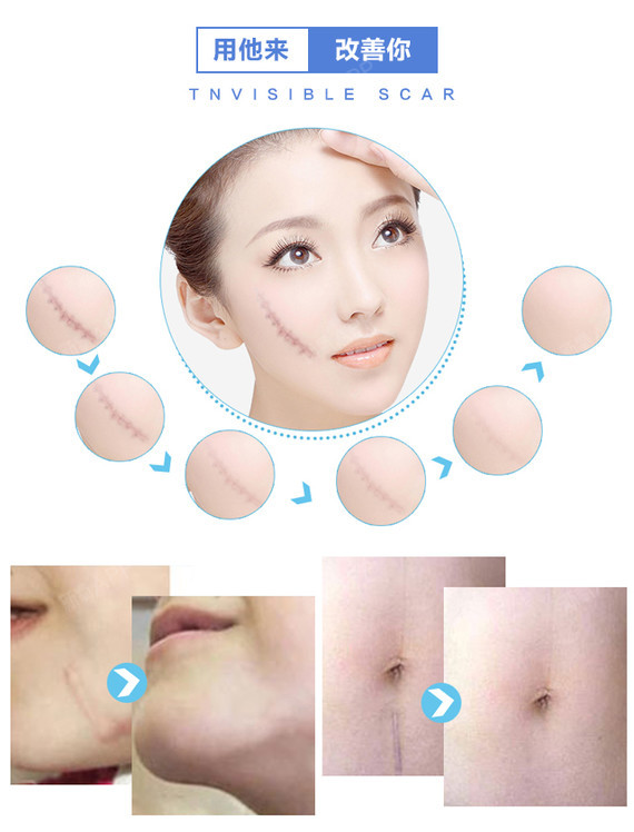 最新疤痕修復技術重塑肌膚之美,重塑肌膚的完美選擇