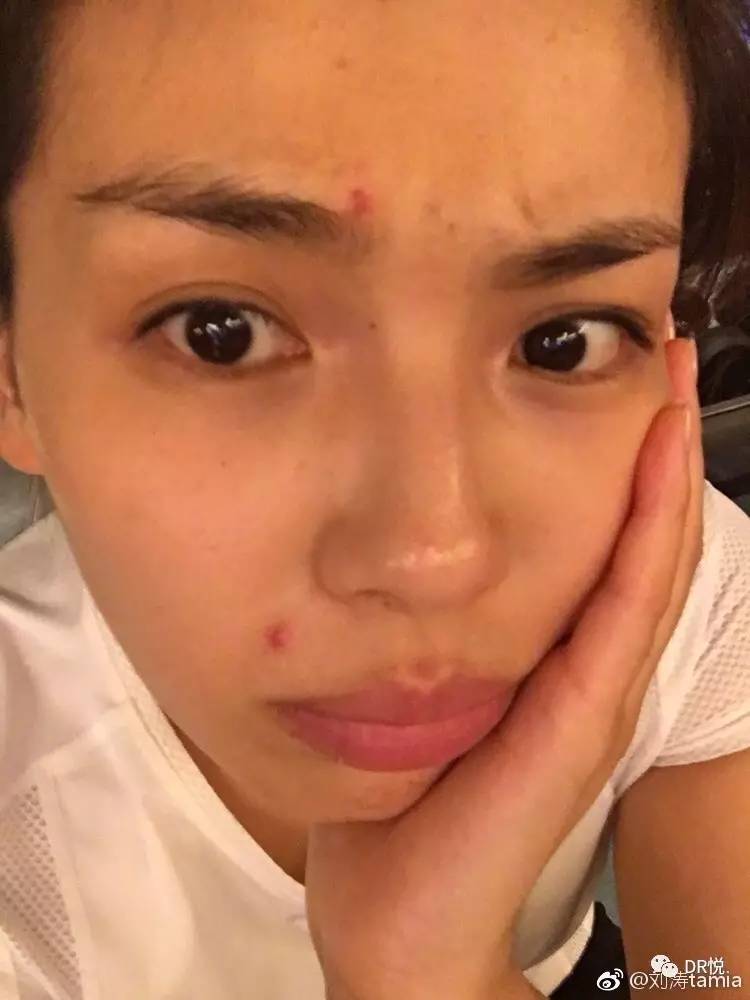 為什么明星不長痘,明星不長痘，背后的故事與真相探尋