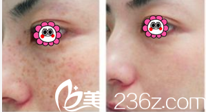 激光祛斑價格詳解與步驟指南